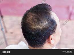 An allergic reaction can be caused by jewelry or health and beauty products, such as shampoo and hair dye. Close Hair Loss Image Photo Free Trial Bigstock