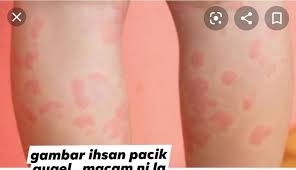 We did not find results for: Asalnya Sakit Dada Badan Jadi Gegata Derita 8 Hari Alami Alergik Tanpa Punca Mingguan Wanita