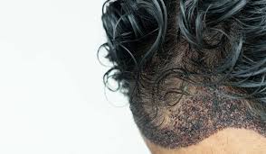 Bei asiaten wachsen die haare schneller als bei afrikanern. Haartransplantation Bei Locken Und Krausen Haaren