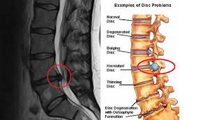 Slip disc adalah keadaan di mana intervertebral disc di tulang belakang memberi tekanan kepada saraf di spinal cord. Jihajumi Rawatan Slip Disc