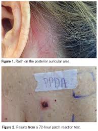 Here is how long you should stay in isolation, assuming that you don't have access to testing. Allergic Contact Dermatitis To Hair Dye Consultant360