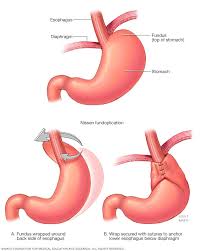 Check spelling or type a new query. Gastroesophageal Reflux Disease Gerd Diagnosis And Treatment Mayo Clinic