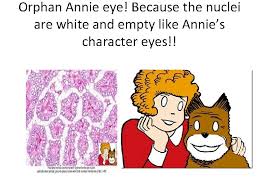 It most often affects younger women there are no good fibrovascular papillae, orphan annie nuclei, or psammoma bodies. Endocrine System Lectures 23 Thyroid Gland Dr Heyam