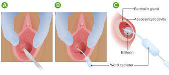 Image result for Bartholin's gland abscess