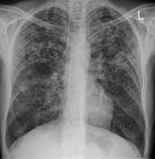 The appearance is typical for chronic pulmonary tuberculosis but may also occur with chronic pulmonary histiocytosis and chronic pulmonary coccidioidomycosis. Miliary Tuberculosis Wikipedia