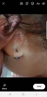 Ear Piercing With Puss Oladoc Com