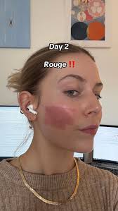 Co 2 Laser Recovery Ftercare Cream