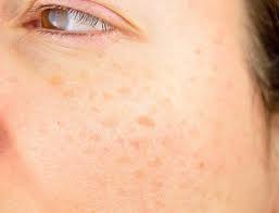 Image result for Solar Lentigo