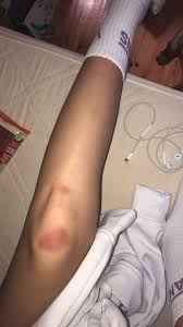 I Always Have Scraped Or Brused Knees Fotos De Biquini Tumblr Fotografia De Moda Criativa Fotos De Sorrisos