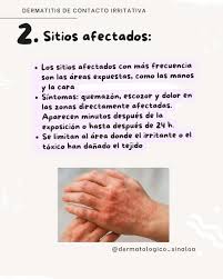 Image result for dermatitis contacta toxica