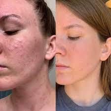 Thought I Had Fungal Acne Now It S Seeming More Like An Allergy Two Day Difference Between Photos Skin Concern Skincareaddiction