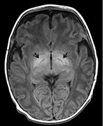 Image result for Kernicterus