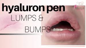 Dos and don'ts after having cosmetic fillers. Filler Lumps And Bumps Hyaluron Pen Youtube