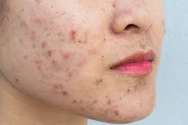 Image result for acne face