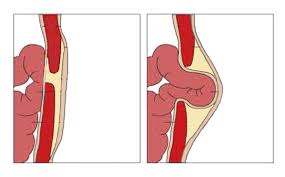 The peritoneal layer is the outer layer of stomach tissue. Hernia Or Pulled Abdominal Muscle Know The Difference Prime Surgicare