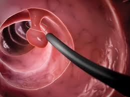 Colonoscopy