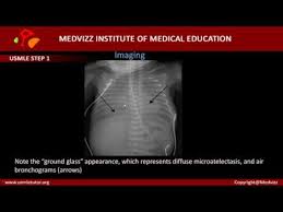 Respiratory Distress Syndrome In Neonates Hyaline Membrane Disease Youtube