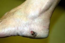 Lumps, swellings, fractures, joint tenderness and pain are some common symptoms of bone cancer in ankle and foot. Foot Melanoma Symptoms Causes And Treatments