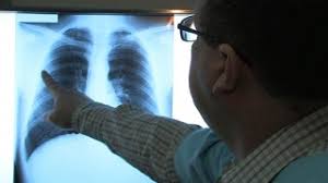 Imaginea bronhiilor/plămânilor apare pe monitorul calculatorului. Telegraf Online Tag Cancer Pulmonar