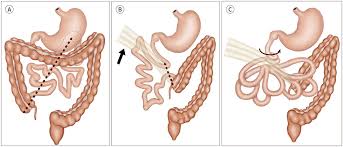 Image result for Midgut Volvulus