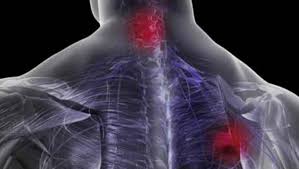 Formele usoare de spondiloza cervicala nu necesita tratament, sau raspund la. Ce Este Spondiloza CervicalÄ Cel Mai Bun Tratament Buna Ziua Iasi Bzi Ro