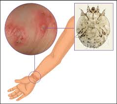 Image result for scabies in the groin area