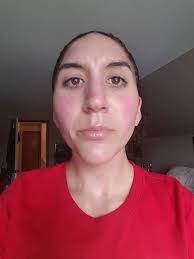 Did you feel like you were burning in the area where you received radiation  treatment afterwards?