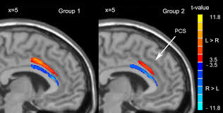 The present paper describes a reliable method for the assessment of the hippocampus, the anterior cingulate cortex, the retrosplenial. Asymmetry Of The Dorsal Anterior Cingulate Cortex Evidences From Multiple Modalities Of Mri Springerlink