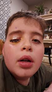 Aaron James is a husband, a father, a military veteran, and an electrical  lineman. He's also the recipient of the world's first-ever whole-eye and  partial face transplant. In June 2021, while working