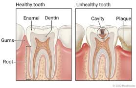 Can you get rid of cavities at home? Tooth Decay In Children Care Instructions