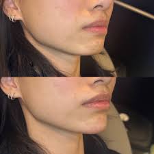 Lower facial balancing using 2 syringes of @revanesse dermal filler. The  clients main concern was her recessed chin, she wanted more projection  while still looking like herself. 'The same, but BETTER' Interested