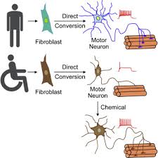 Doctors usually don't know why als occurs. Direct Lineage Reprogramming Reveals Disease Specific Phenotypes Of Motor Neurons From Human Als Patients Cell Reports