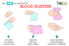 The symptoms are often mild, though some patients may feel moderate pain at the site of the blister. How To Get Rid Of Blood Blisters Top 10 Home Remedies