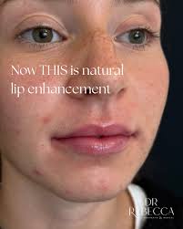 One of the most important things you can do when choosing an injector-  after choosing someone who is medical and appropriately trained, is to find  someone who has a good aesthetic eye.