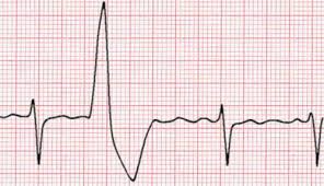 Pvcs may be unifocal (see above), multifocal (see below) or finally a pvc may retrogradely capture the atrium, reset the sinus node, and be followed by an under these circumstances atrial contractions may occur when the tricuspid valve is still closed. Ventricular Ectopic Beats Dr Richard Bogle Phd Frcp Fesc Facc Dhmsaconsultant Cardiologist