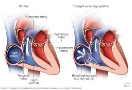 Tricuspid Valve Regurgitation Symptoms And Causes Mayo Clinic Tricuspid Valve Valve Pulmonary