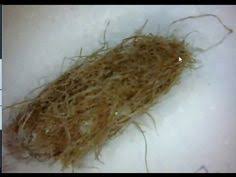 Saveli vr, leitao mm, stricker rb. Morgellons Syndrome