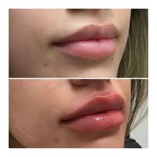 How long does it take for juvederm to settle in lips. Lip Augmentation In Wexford Pa Face Forward Aesthetics