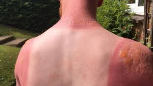Lidah buaya terkenal dengan khasiatnya yang menyembuhkan berbagai macam luka termasuk menghilangkan. 14 Cara Hilangkan Sunburn Dengan Cepat Semulajadi Moden Infosantai