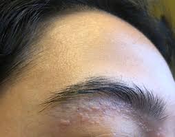 Then, very gently, exfoliate the skin trapping the hair. Bumps Under My Eyebrow I Noticed I Get More After Plucking My Hairs But Don T Think They Re Ingrown Hairs Is It Just Irritation And How Can I Get Rid Of Them
