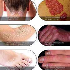 Learn how you can treat your psoriasis and live the healthiest you. Les X Psoriase Home Facebook