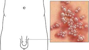 Häufig verläuft die erstinfektion unbemerkt. Herpes Genitalis So Lasst Es Sich Erkennen Und Behandeln Focus Arztsuche