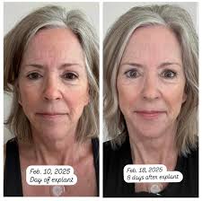 2 weeks post op question I know its gonna take quite some time to heal. I  would like to hear from you guys and what time frame did your boobs fluff  back