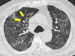 Manage these post covid cardiovascular. Respiratory Follow Up Of Patients With Covid 19 Pneumonia Thorax