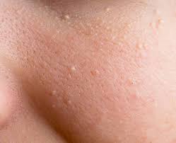 Image result for milium cyst on eyelid