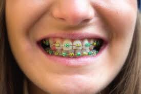 braces vs invisalign difference and comparison diffen