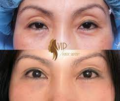 Pin On Blepharoplasty