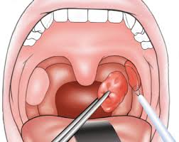 The average tonsil removal surgery cost is directly reliant on several parts, such as geographic area, the office in which the surgery is how much to remove tonsils will also differ depending upon location. Tonsillectomy Adenoidectomy Surgery Best Hospitals Tonsil Removal Removal Surgery