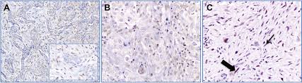 In the present study, we examined the prevalence of bap1 loss in wdpm by immunohistochemistry with clinical correlation, along with cdkn2a deletion status by fluorescence in situ hybridization (fish). Brca1 Associated Protein 1 Bap1 Immunohistochemical Expression As A Diagnostic Tool In Malignant Pleural Mesothelioma Classification A Large Retrospective Study Journal Of Thoracic Oncology