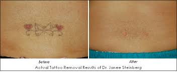 Want to find out who they refer? Tattoo Removal Photos News Cost Reviews Locate Provider Ahb